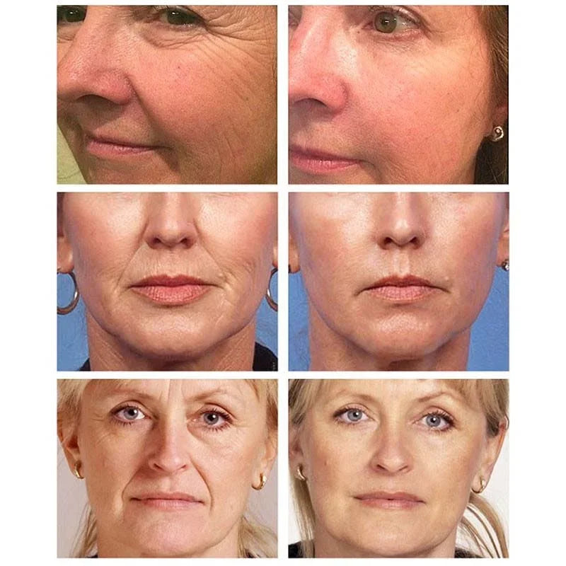 Retinol Face Cream Anti-Aging Wrinkle Remover Firming Lifting Skin Care Fade Fine Lines Whitening Moisturizing Korean Cosmetics